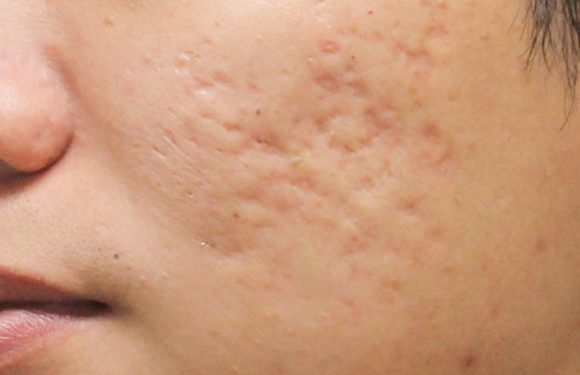 Acne Scar Treatment: How to Get Rid of Depressed Acne Scars for Good