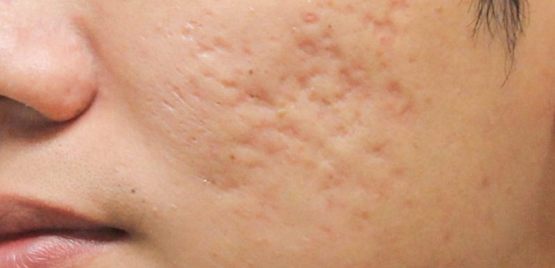 Acne Scar Treatment: How to Get Rid of Depressed Acne Scars for Good