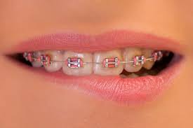 How Do Braces Work?