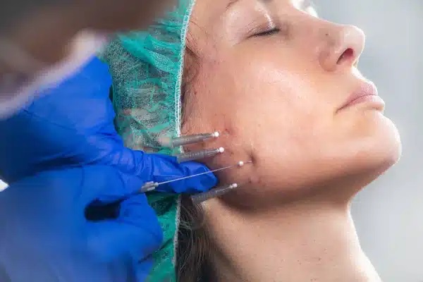 Dermal fillers