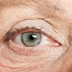 Macular Degeneration