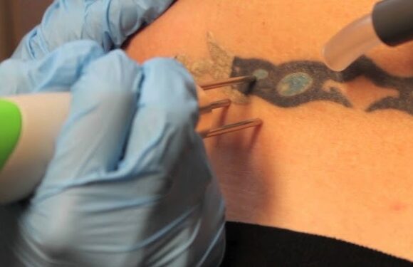 Neatcell Tattoo Removal Reviews: Honest User Experiences