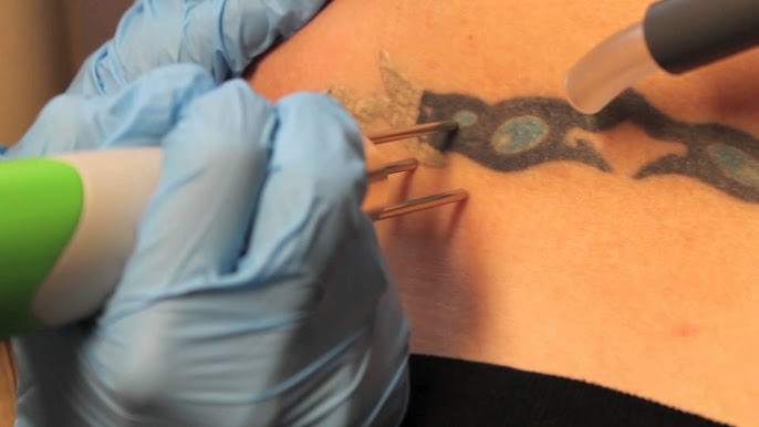 Neatcell Tattoo Removal Reviews: Honest User Experiences