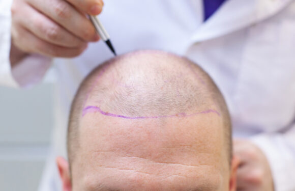 Micropigmentation services are a popular choice for hair restoration