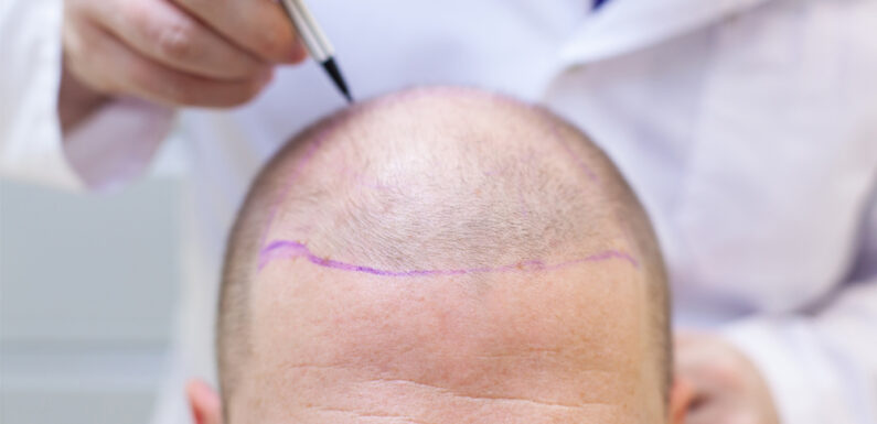 Micropigmentation services are a popular choice for hair restoration